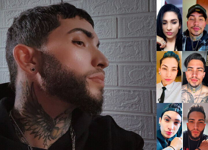 Allan: El Trasplante de Barba que Masculinizó su Imagen