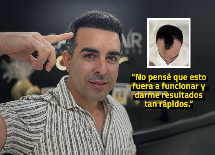 Angel y su Restauración Capilar de 4000 Foliculos
