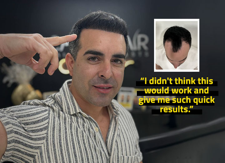 Angel’s 4,000 Follicles Hair Restoration Story