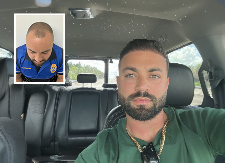 3000-Grafts Hair Transformation Patient Story