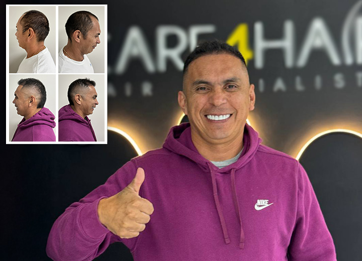 John Buitrago y su Restauración de Línea frontal con 4000 folículos