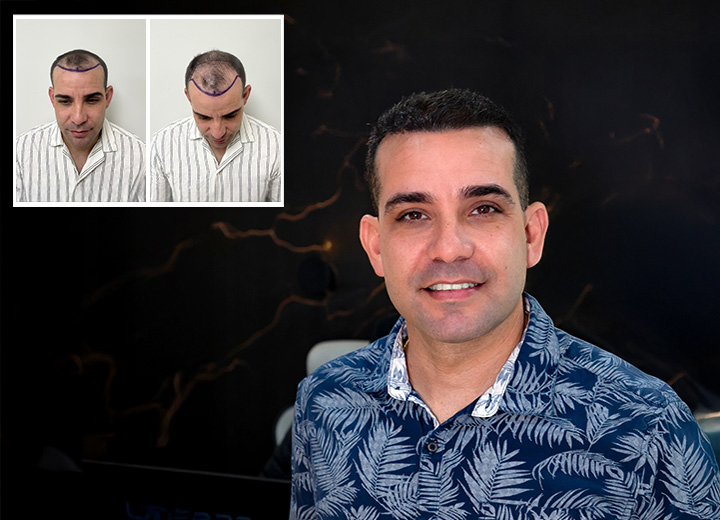Loivwer’s Story: 3,500-Graft Hair Transplant Results