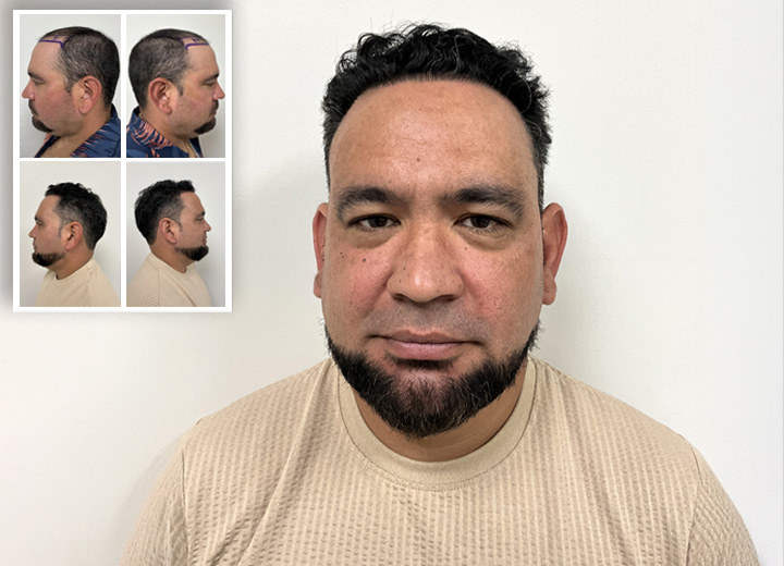 Luis Sánchez: De la Duda a la Transformación Capilar con Care4Hair