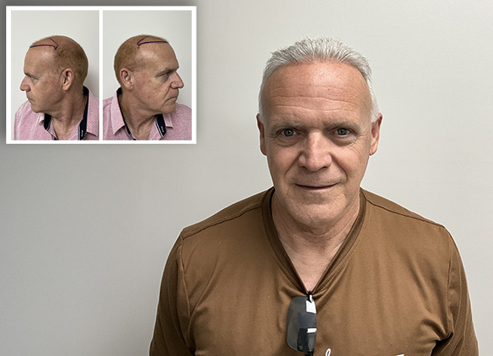 Carlos Calero, Dos Rondas de Trasplante Para Recuperar el Cabello 