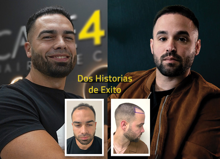 Yasiel y Jorge: Dos historias de éxito en Care4Hair
