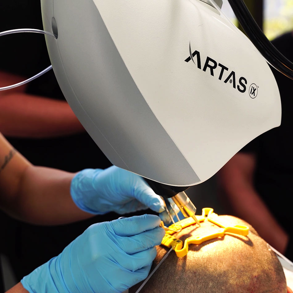 artas hair transplantation