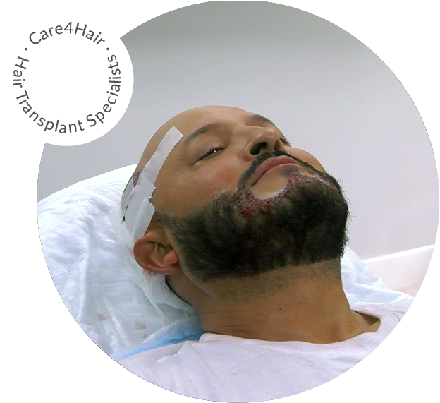 beard hair transplant image