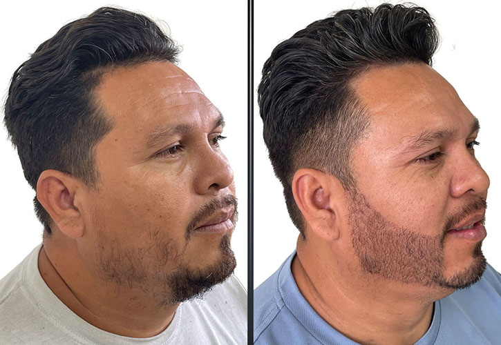 beard hair transplant miami