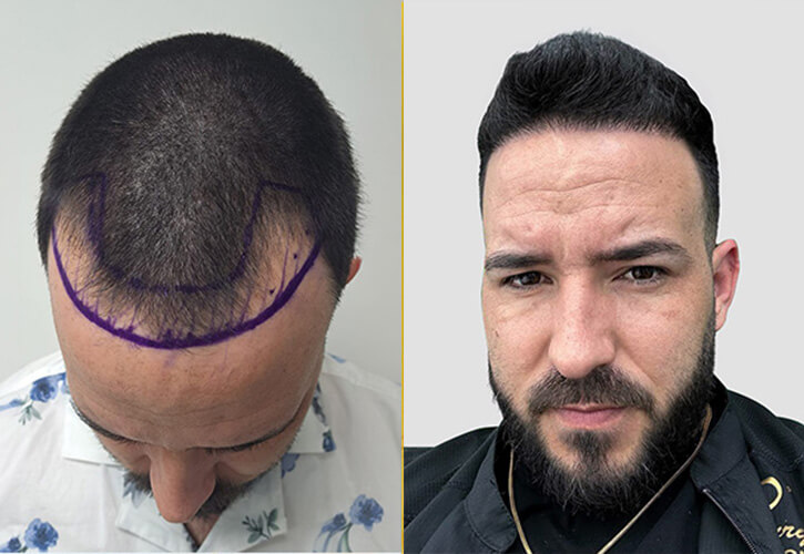 Trasplante de cabello Directo DHI