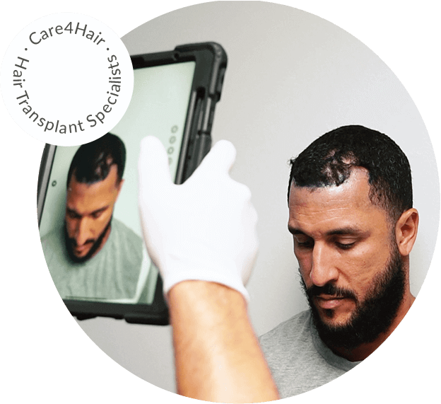 hair transplant miami