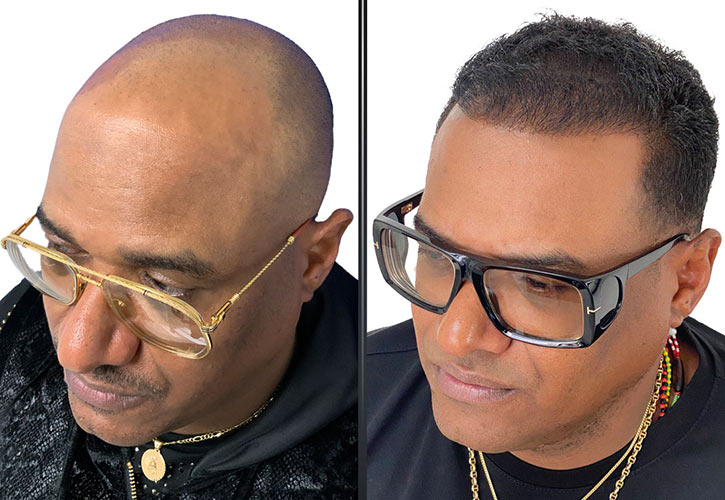 Ethnic hair transplant Miami