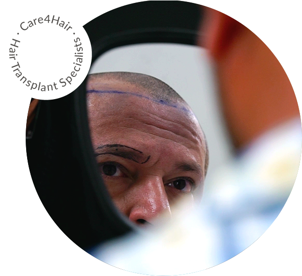 Hair Loss Treatment Options