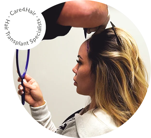 hair transplant for Women in Miami