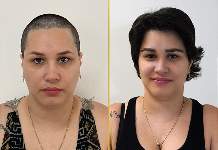 female hair transplant in miami