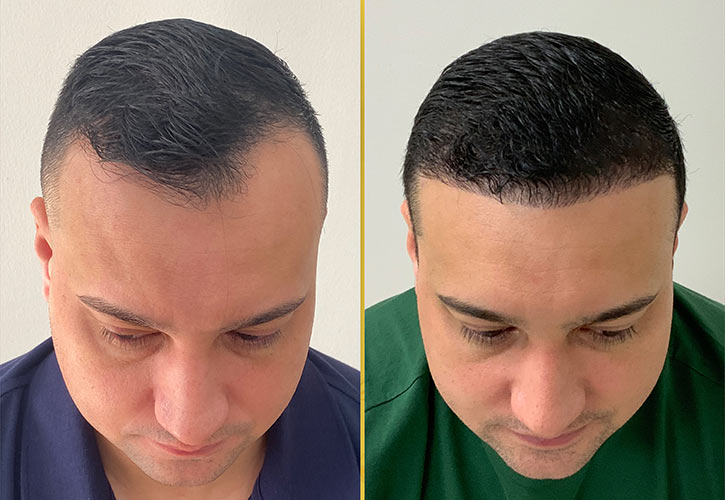 Hairline Restoration in Miami
