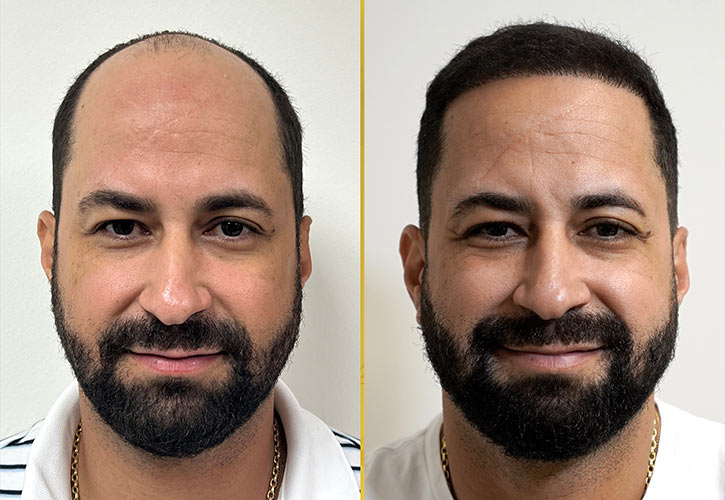 Male Hair Transplant in Miami