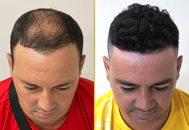Neograft Hair Transplant in Miami