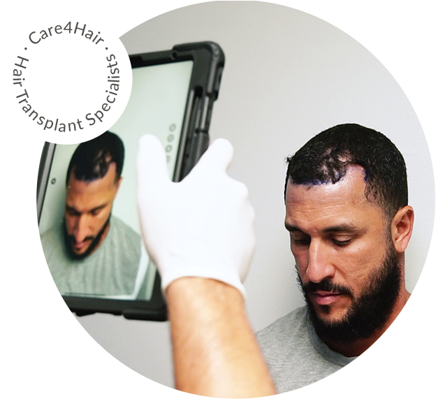 hair loss evaluation before hair transplant