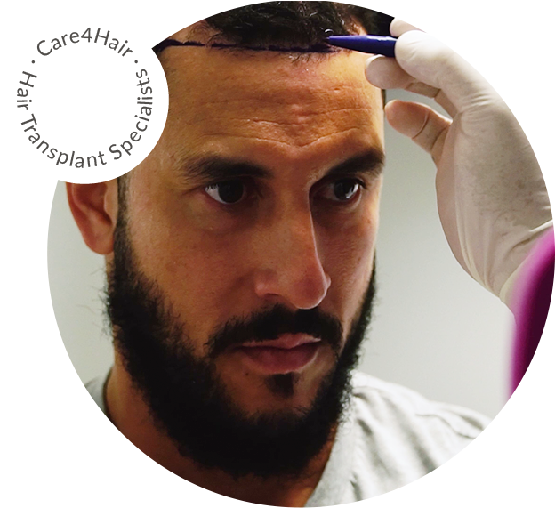 trasplante de cabello para hombres