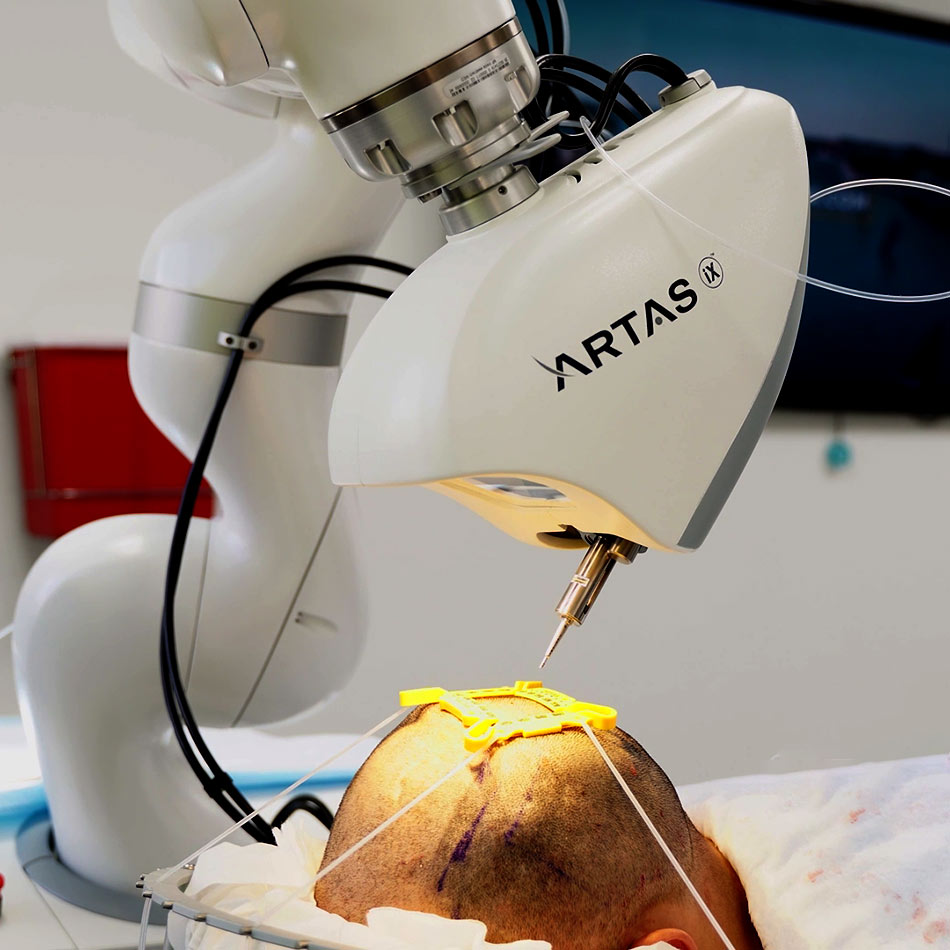 robotic hair transplantation ARTAS machine