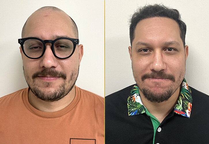 Trasplante de cabello FUE con punta de zafiro en Miami