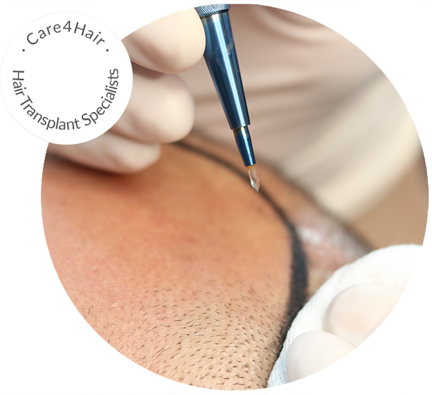 Tecnica FUE con Zafiro