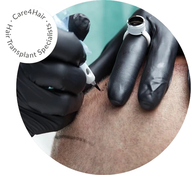 micropigmentación del cuerpo cabelludo en Maimi