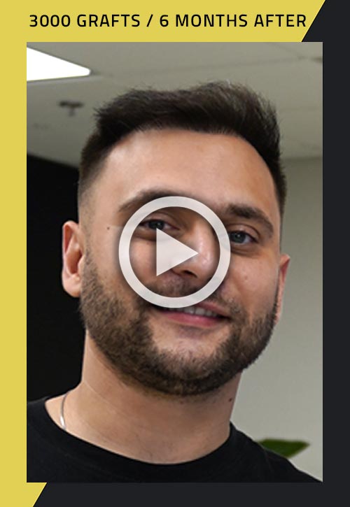 3000-graft hair transplant patient 6 months after video