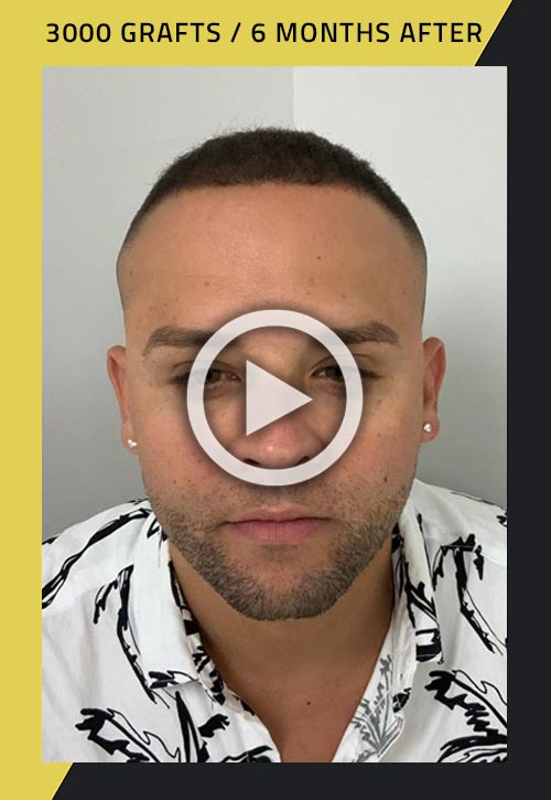 3000-follicles FUE hair transplant patient six months after video