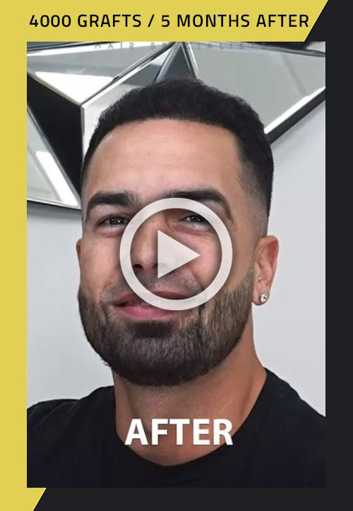 4000-grafts hair restoration surgery five months after video