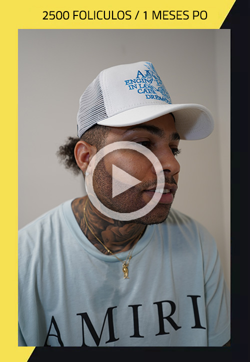 Trasplante de barba en paciente afroamericano: video de caso 23