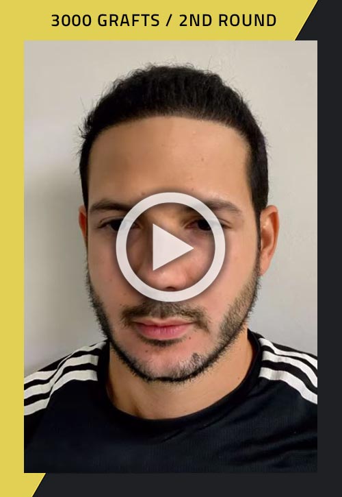 3000-grafts 2nd-round hair transplant surgery video