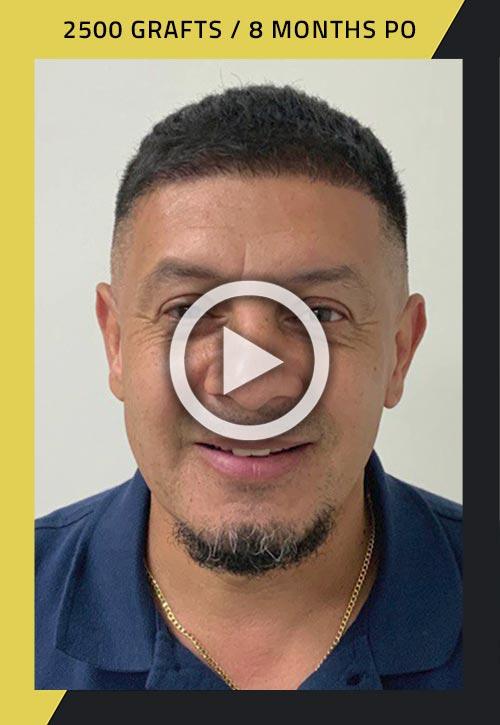 2500-grafts hair transplant 8 months post surgery video