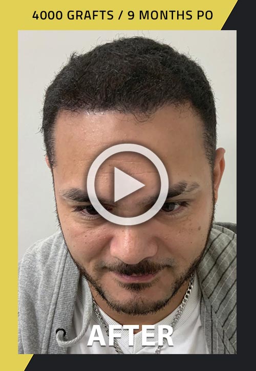 4000-grafts ethnic hair transplant 9 months post surgery video