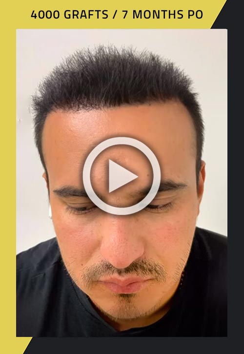 4000-grafts hair transplant 7 months post surgery video