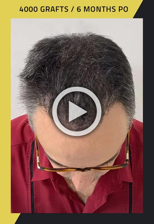 4000-grafts hair transplant surgery 6 months after video