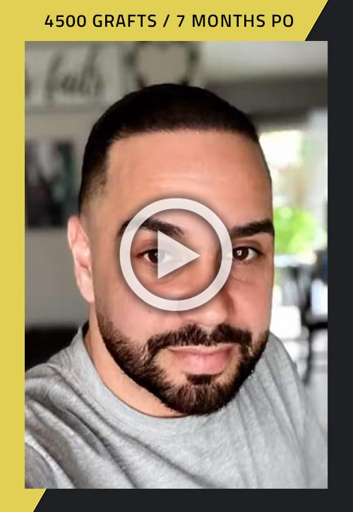 4500-grafts hair transplant seven months after procedure video