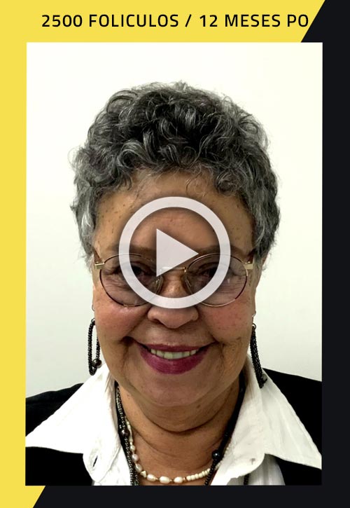 Vídeo de trasplante de cabello femenino de 2500 injertos 1 año después