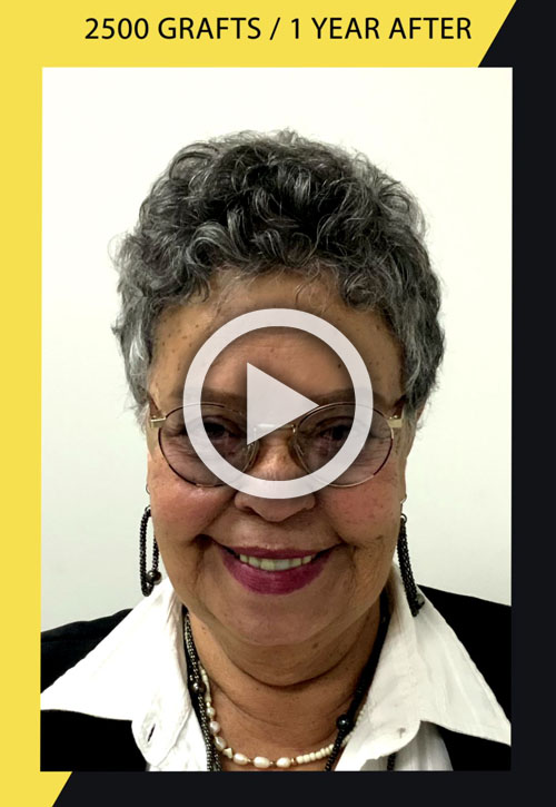 2500 grafts hair transplant 1 year after video