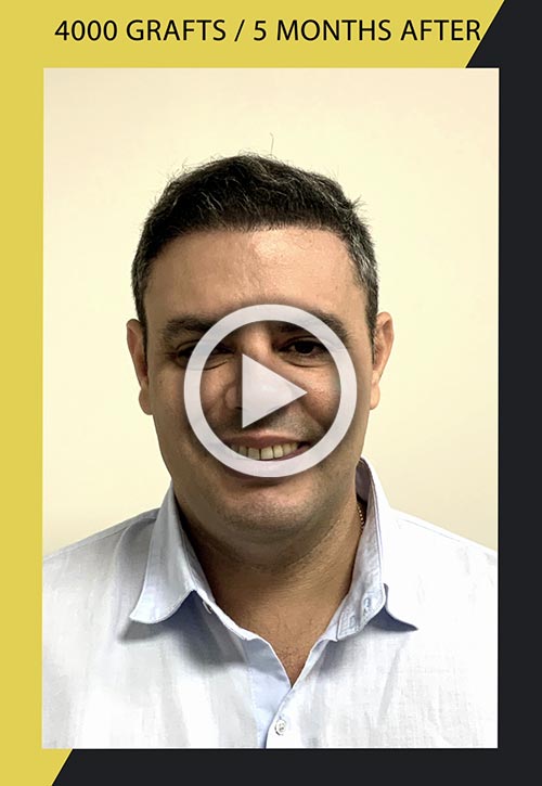 Video de Trasplante de cabello de 4500 injertos cinco meses después