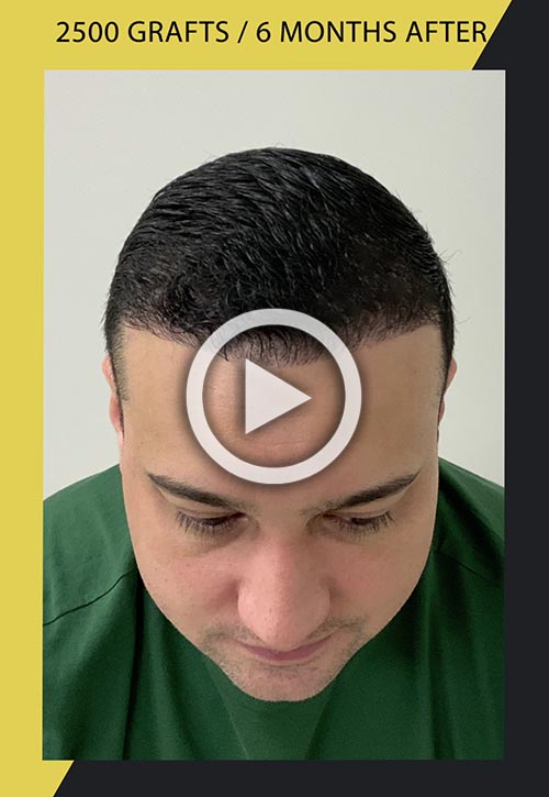 Vídeo de trasplante de cabello de 2500 injertos 6 meses después