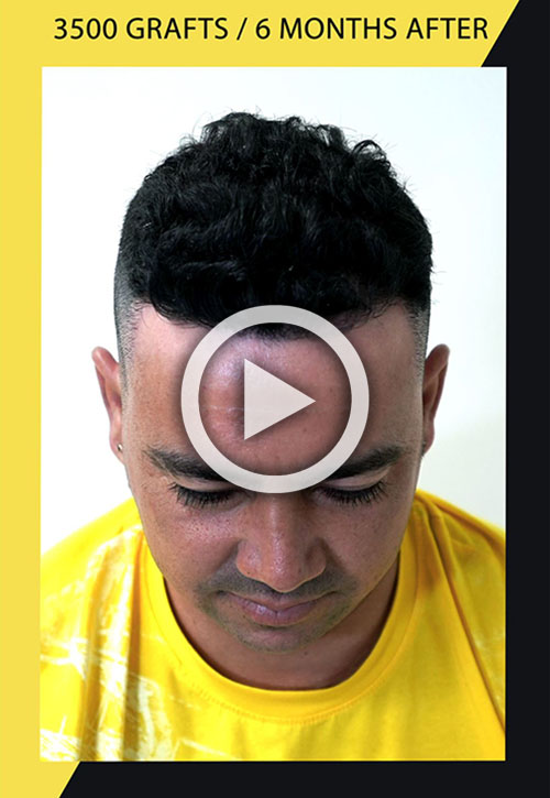3500 grafts hair transplant 6 month after video