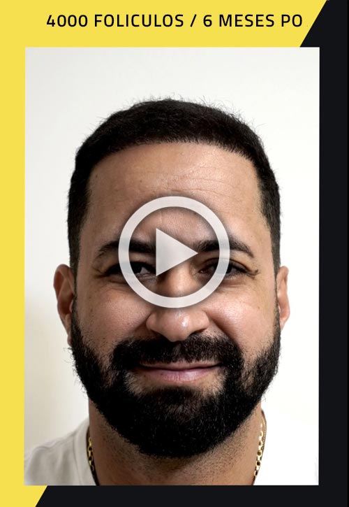 Vídeo de trasplante de cabello de 4000 injertos 6 meses después