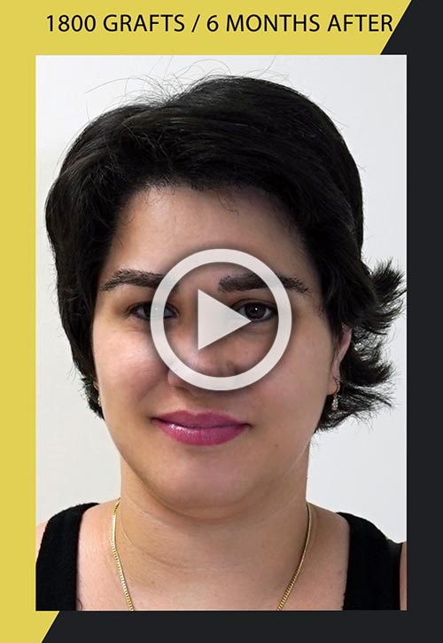 Video de Restauración de la línea del cabello en una mujer con 1800 injertos 6 meses después