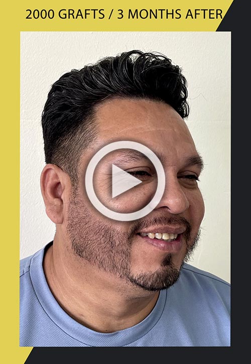 Vídeo de trasplante de barba de 2000 injertos 3 meses después