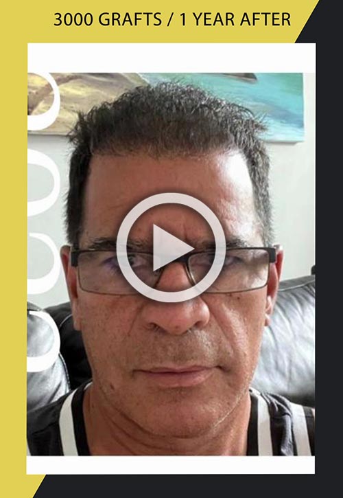 Vídeo de trasplante de cabello masculino de 3000 folículos un año después de la cirugía