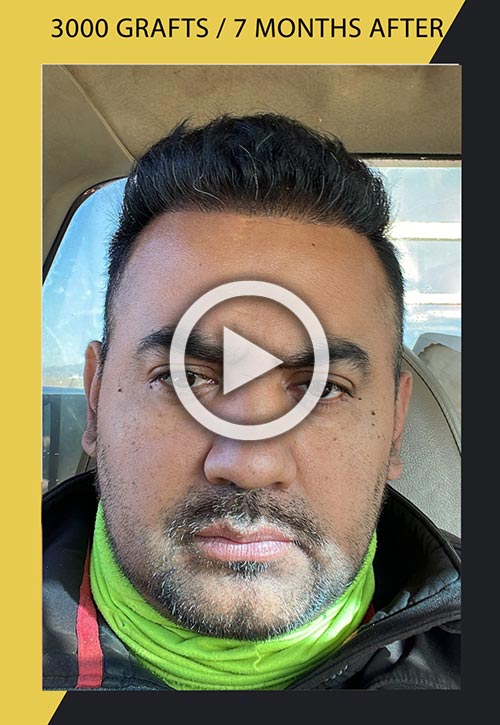 Vídeo de trasplante de cabello de 3000 injertos 7 meses después