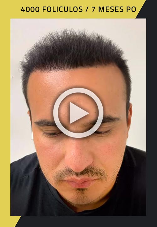 Vídeo de trasplante de cabello de 4000 injertos a los 7 meses de la cirugía