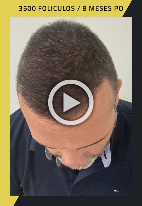Vídeo de trasplante de cabello de 3500 injertos 8 meses después