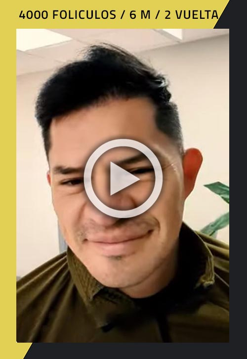Vídeo de trasplante de cabello (segunda ronda)  de 4000 injertos 6 meses después de la cirugía